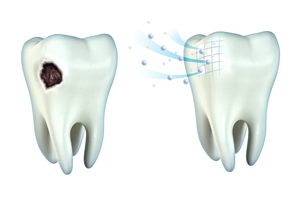 Tooth Cavity and Remineralization