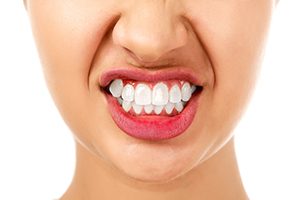 Woman with Bruxism