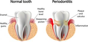 Normal Tooth vs Periodontitis