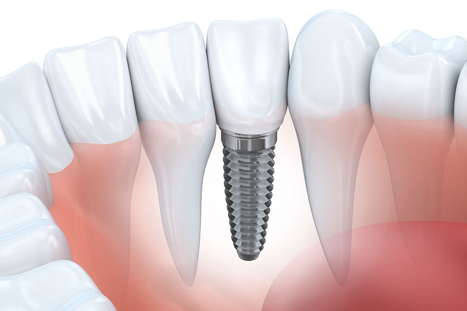 Dental Implants