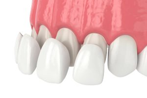 Beautful Porcelain Veneers