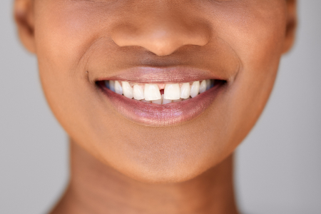 Diastema Gap Teeth