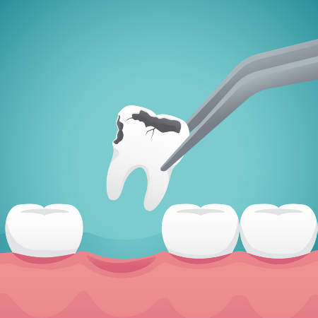 Tooth Extraction, Dry Socket