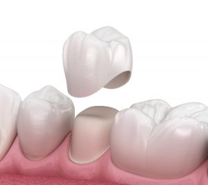 Placement of Premolar Dental Crown