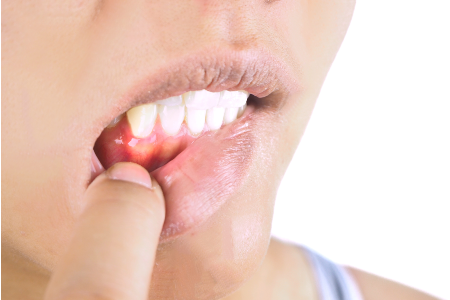 Gums Hurt from Periodontal Disease