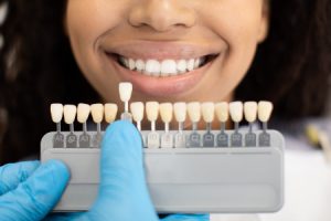 Teeth Whitening Shade Match