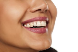 Smiling Woman Porcelain Veneers