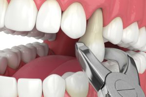 Tooth Extraction