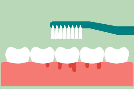 Brushing Teeth & Bleeding Gums