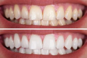 Teeth Whitening Before & After