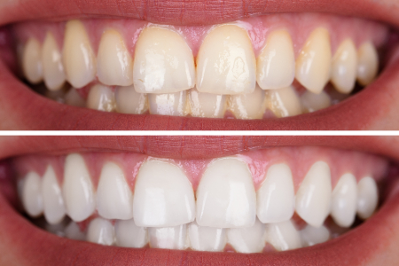 Teeth Whitening Before & After