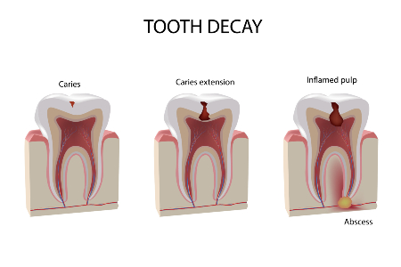 Tooth Decay Stages