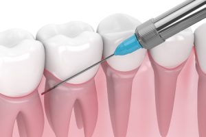 Dental Anesthesia Injection