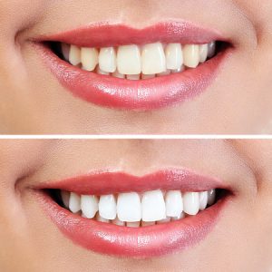 Teeth Whitening Results Before & After