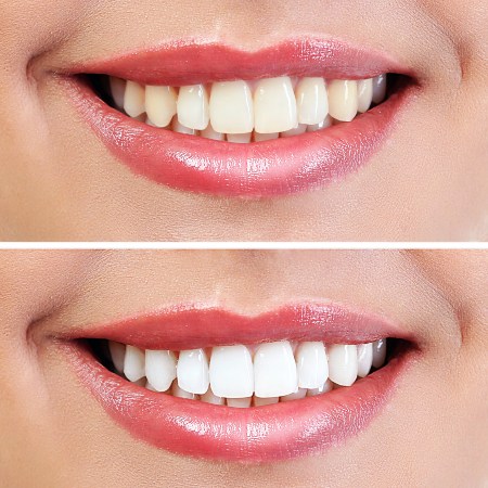 Teeth Whitening Results Before & After